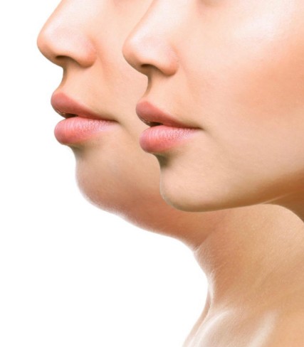 Double Chin Fat Dissolving Treatment